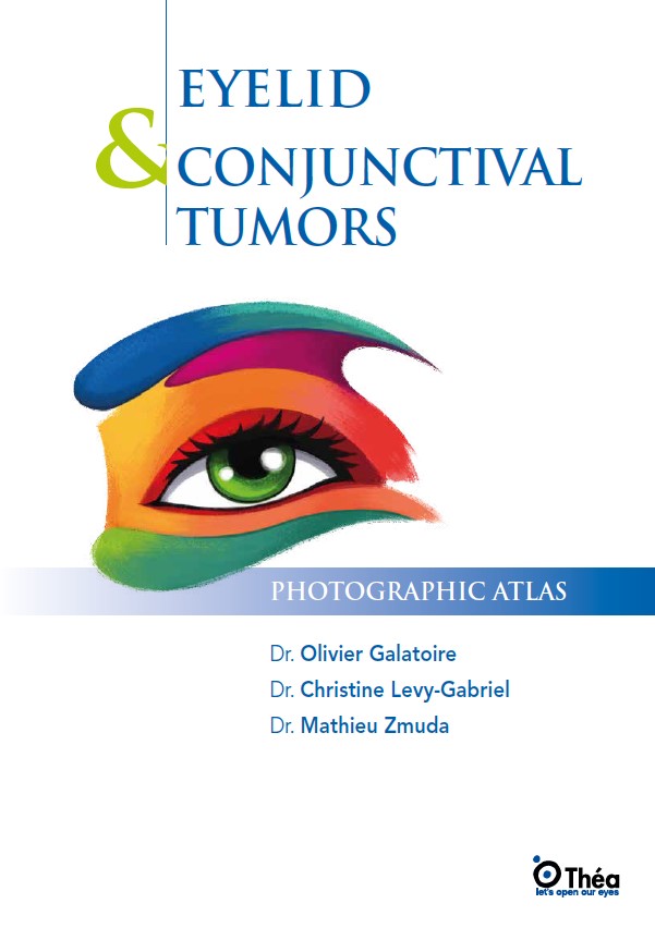 Eyelid & conjunctival tumors