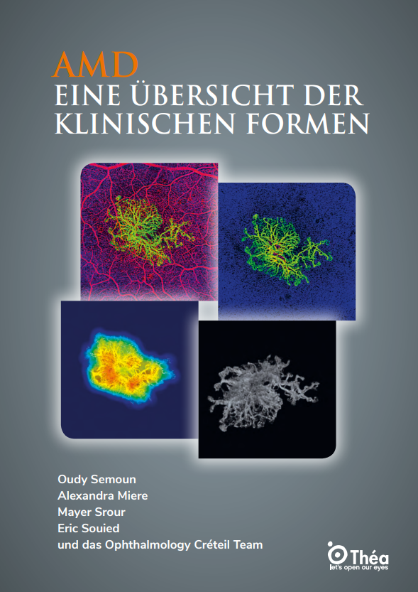 Amd – eine übersicht der klinischen formen