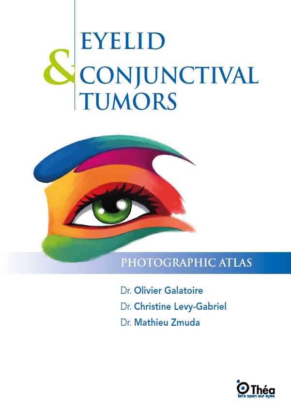 Eyelid and conjunctival tumors: a comprehensive guide for ophthalmologists